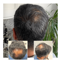 Hair Transplant  Brentwood Essex