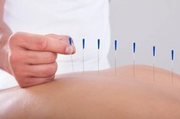 Acupuncture Therapy NYC